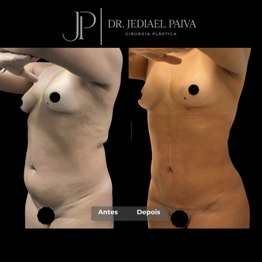 Lipoescultura — antes e depois