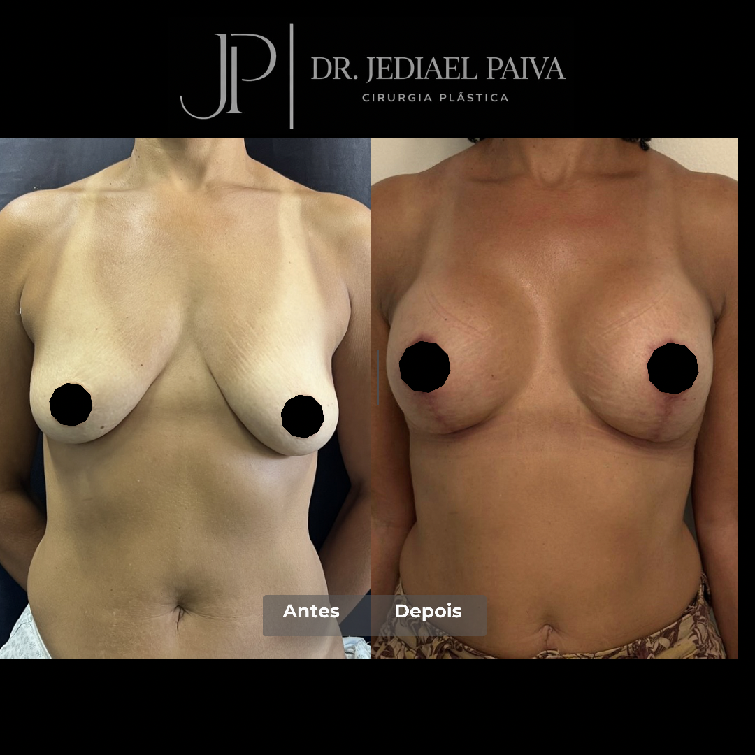 Mamoplastia — antes e depois