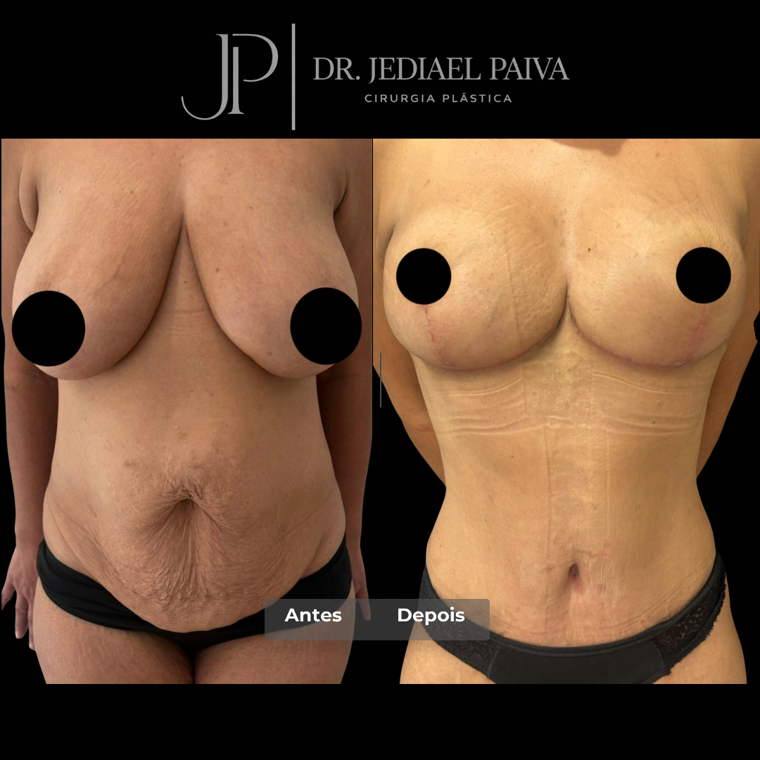 Mummy makeover — antes e depois
