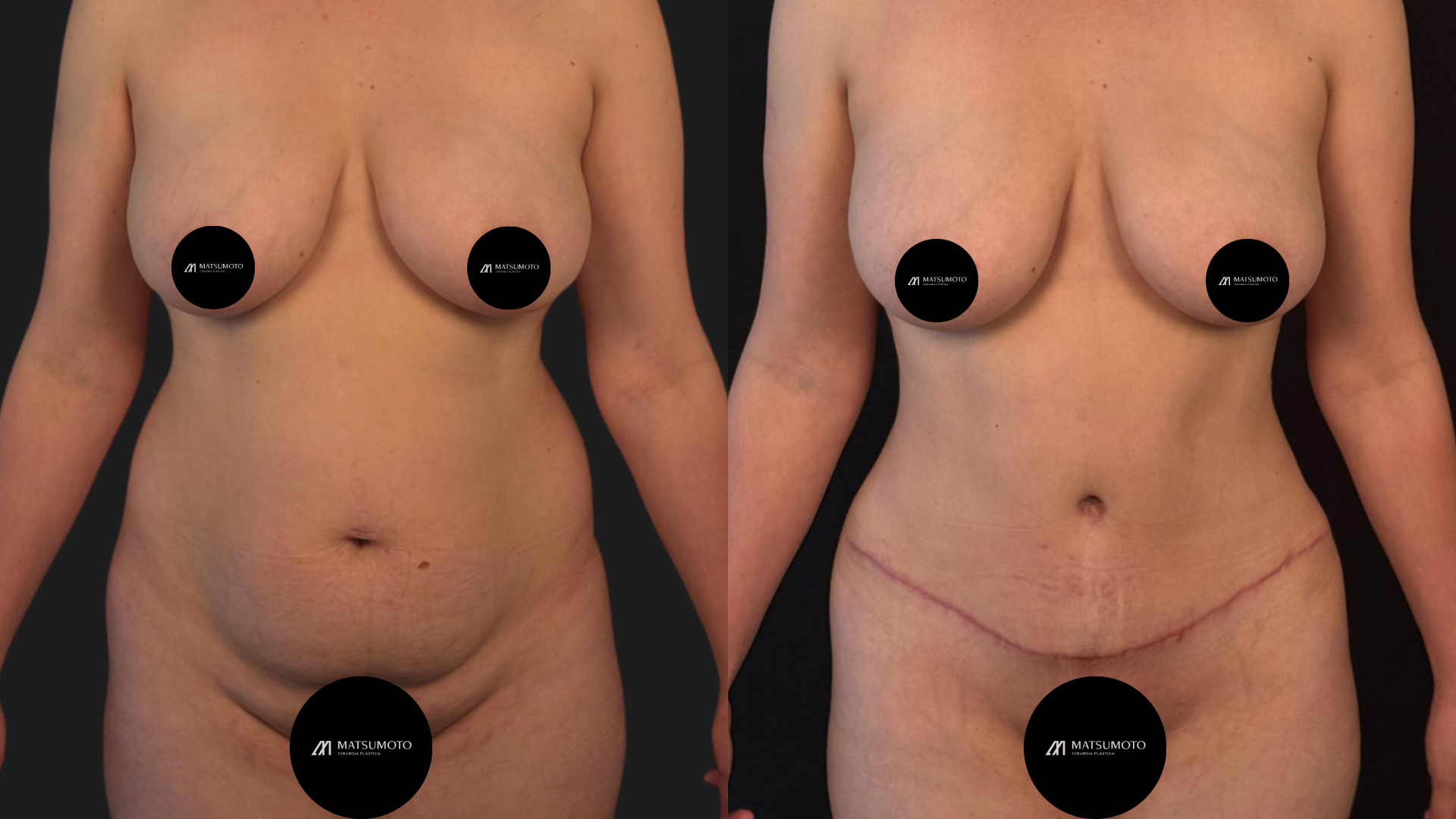Abdominoplastia — antes e depois