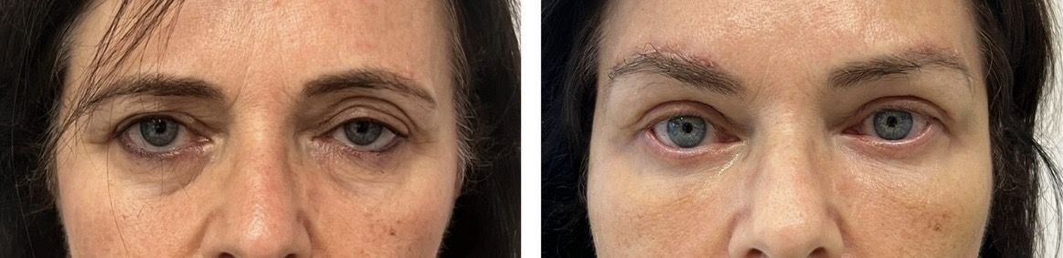Blefaroplastia — antes e depois
