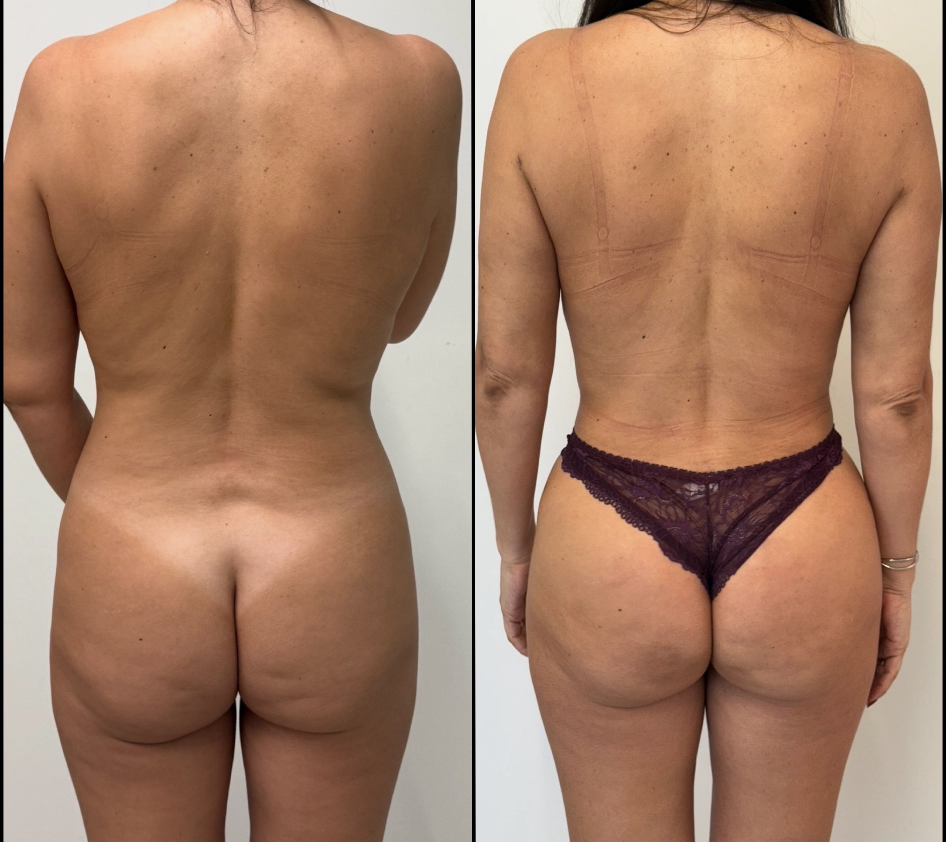 Lipoescultura — antes e depois