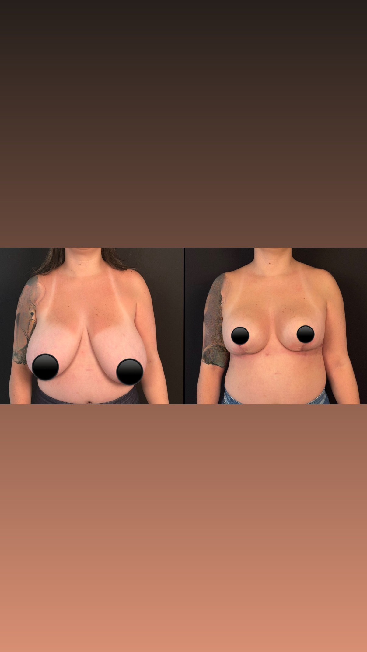 Mamoplastia — antes e depois