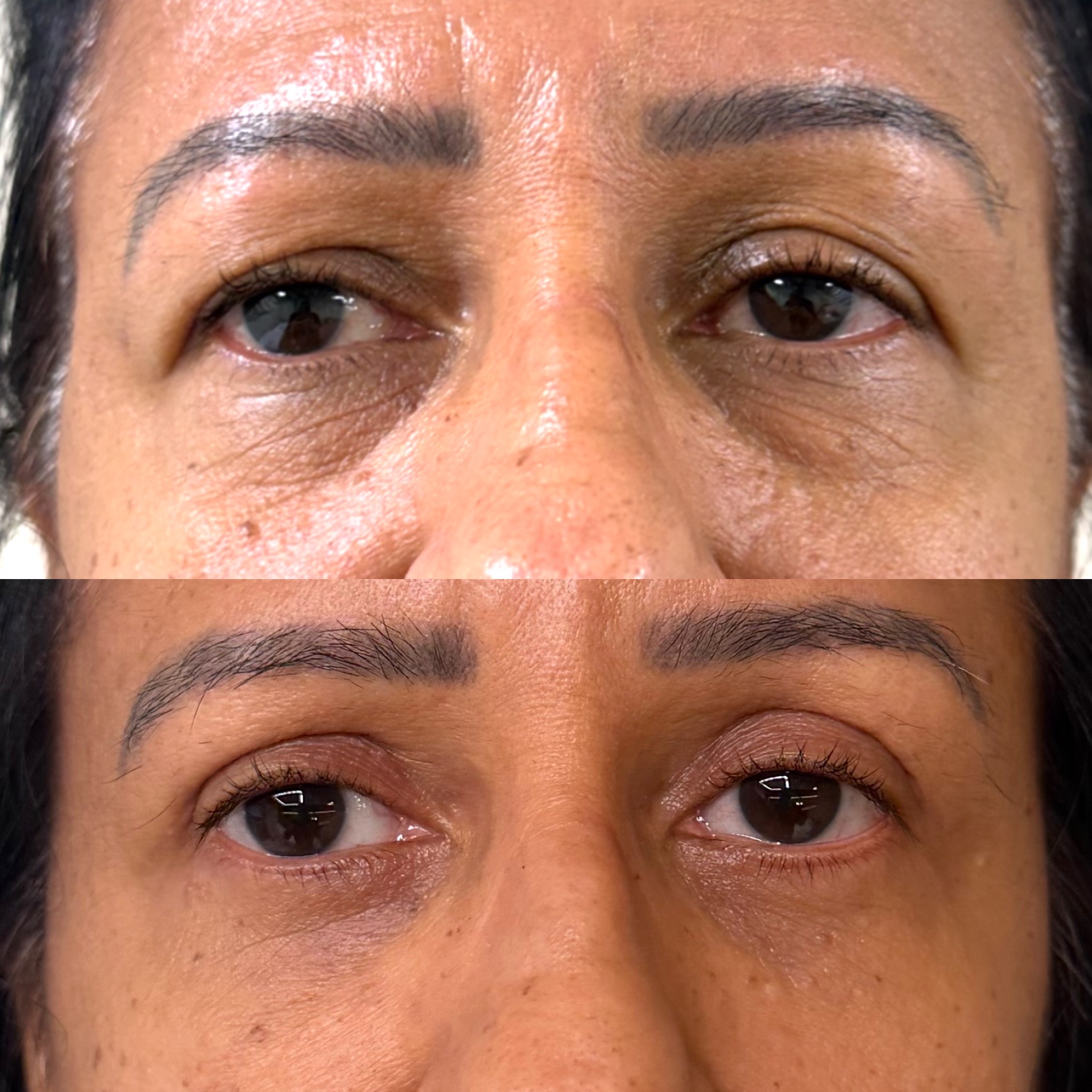 Blefaroplastia — antes e depois