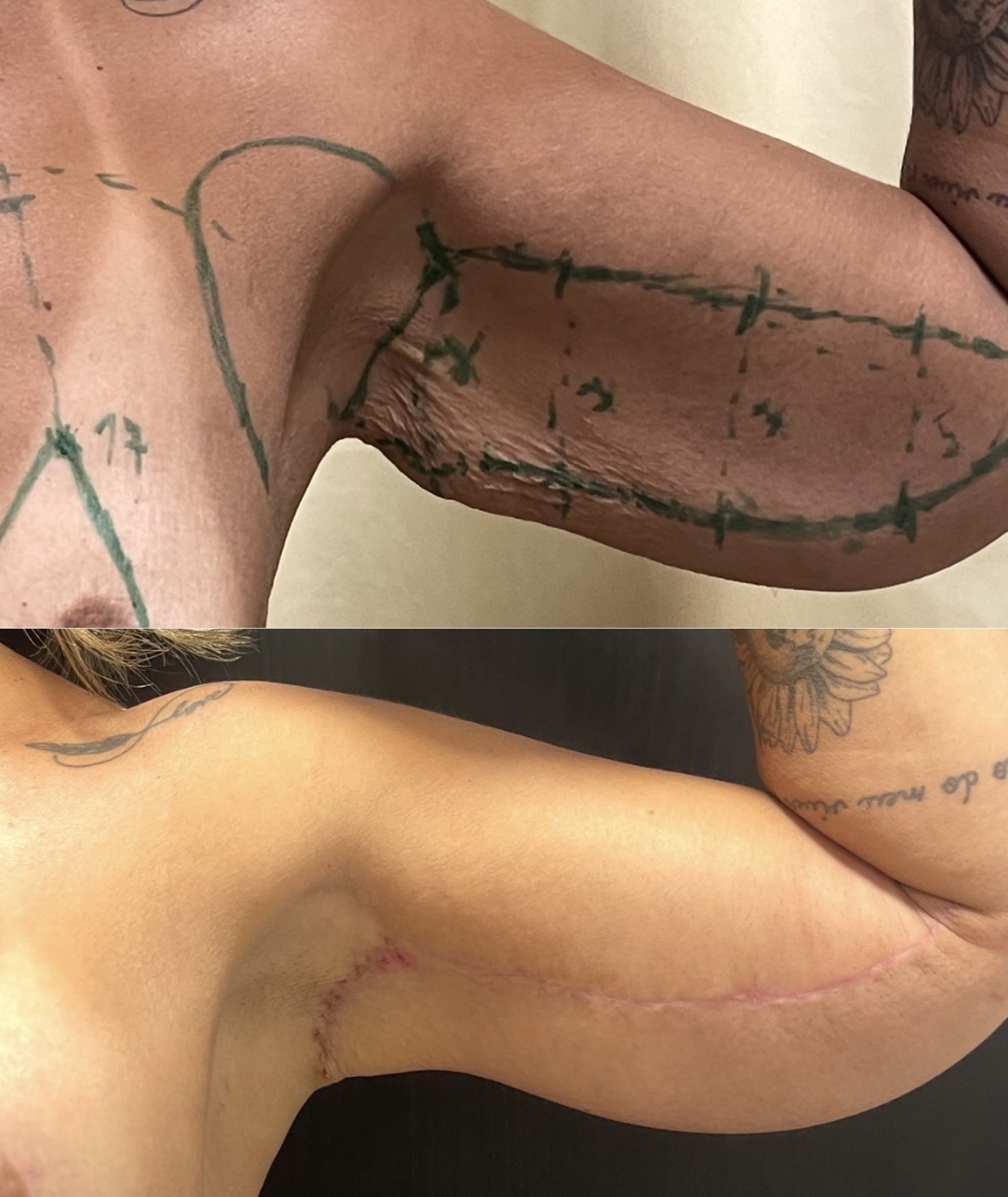 Braquioplastia — antes e depois