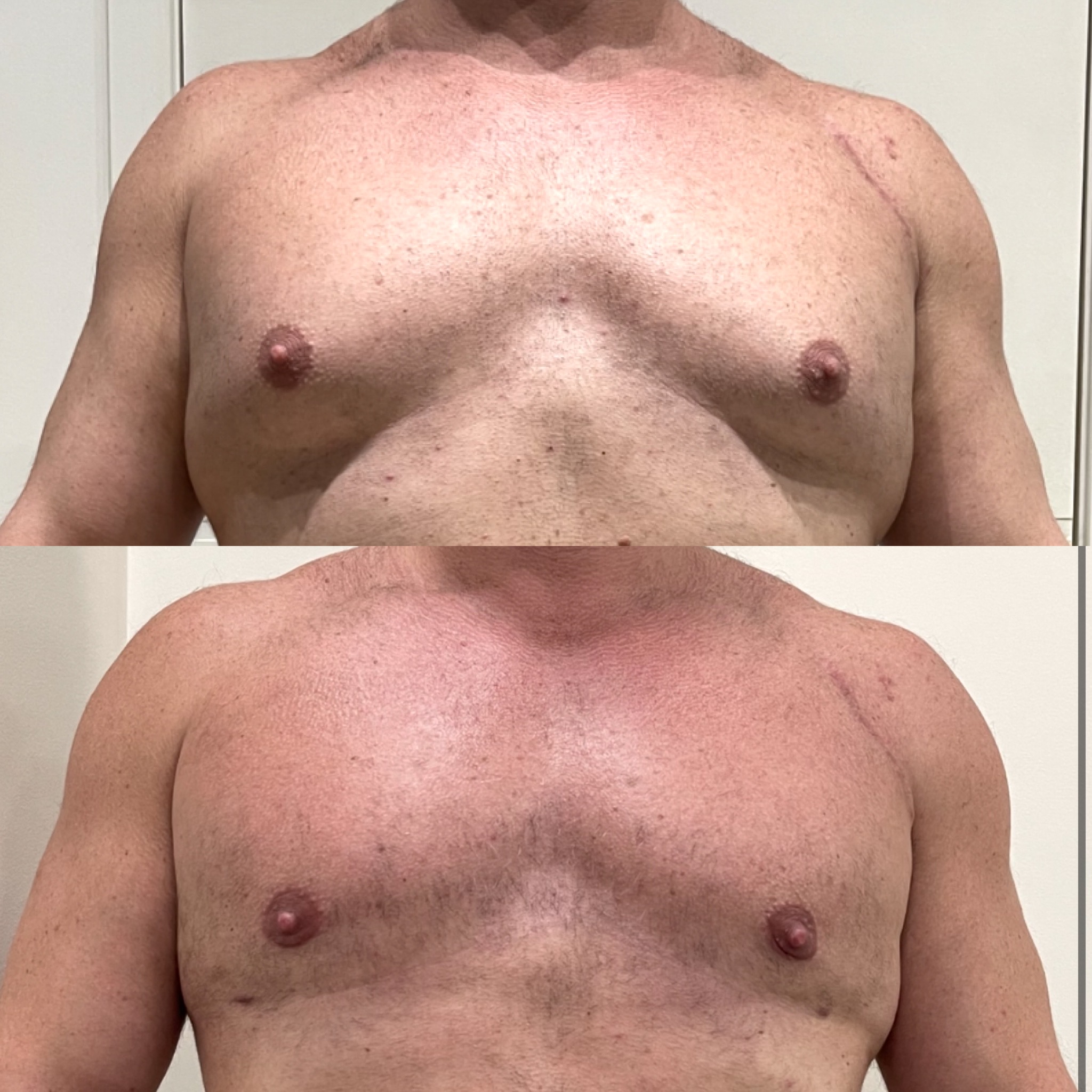 Ginecomastia — antes e depois