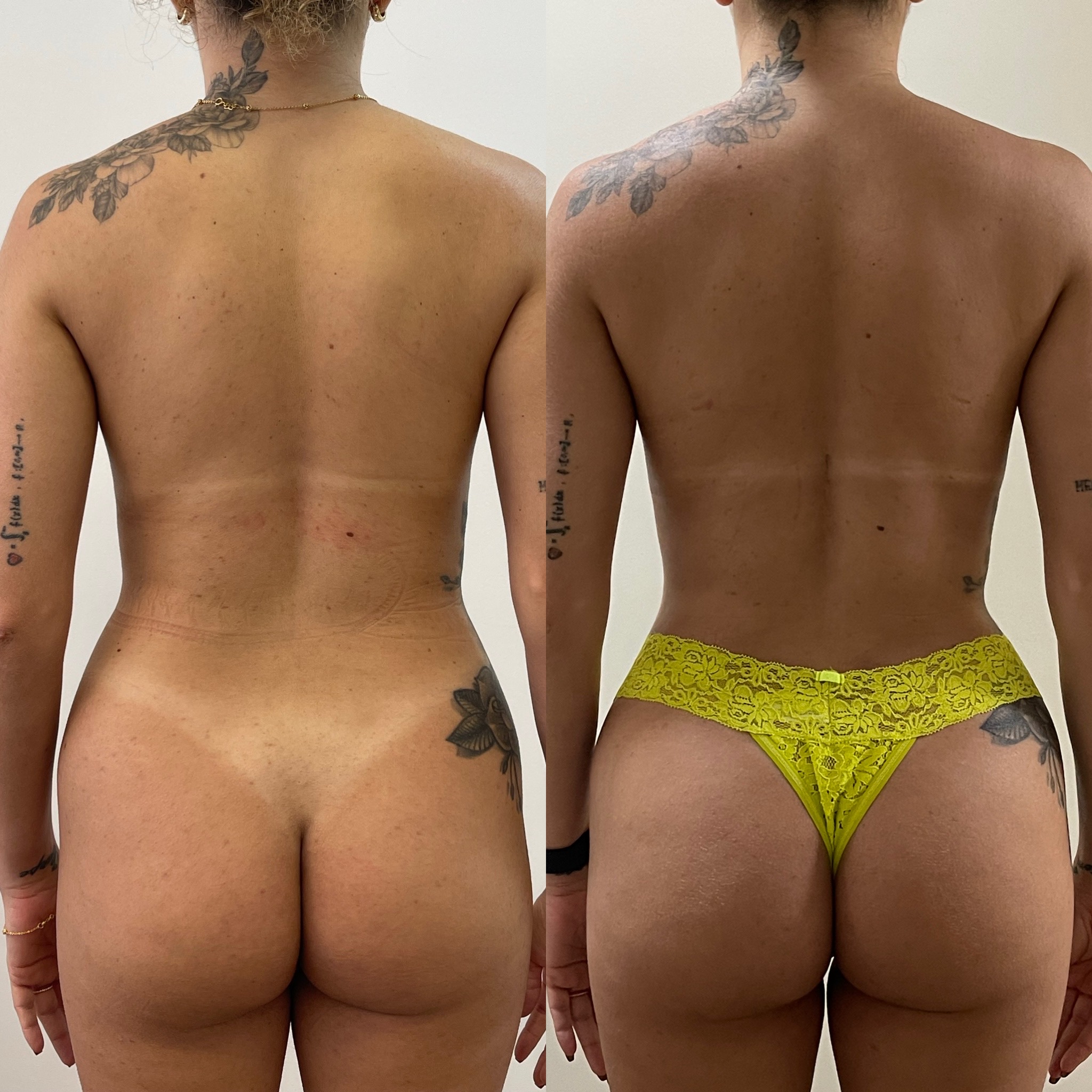 Lipoescultura — antes e depois