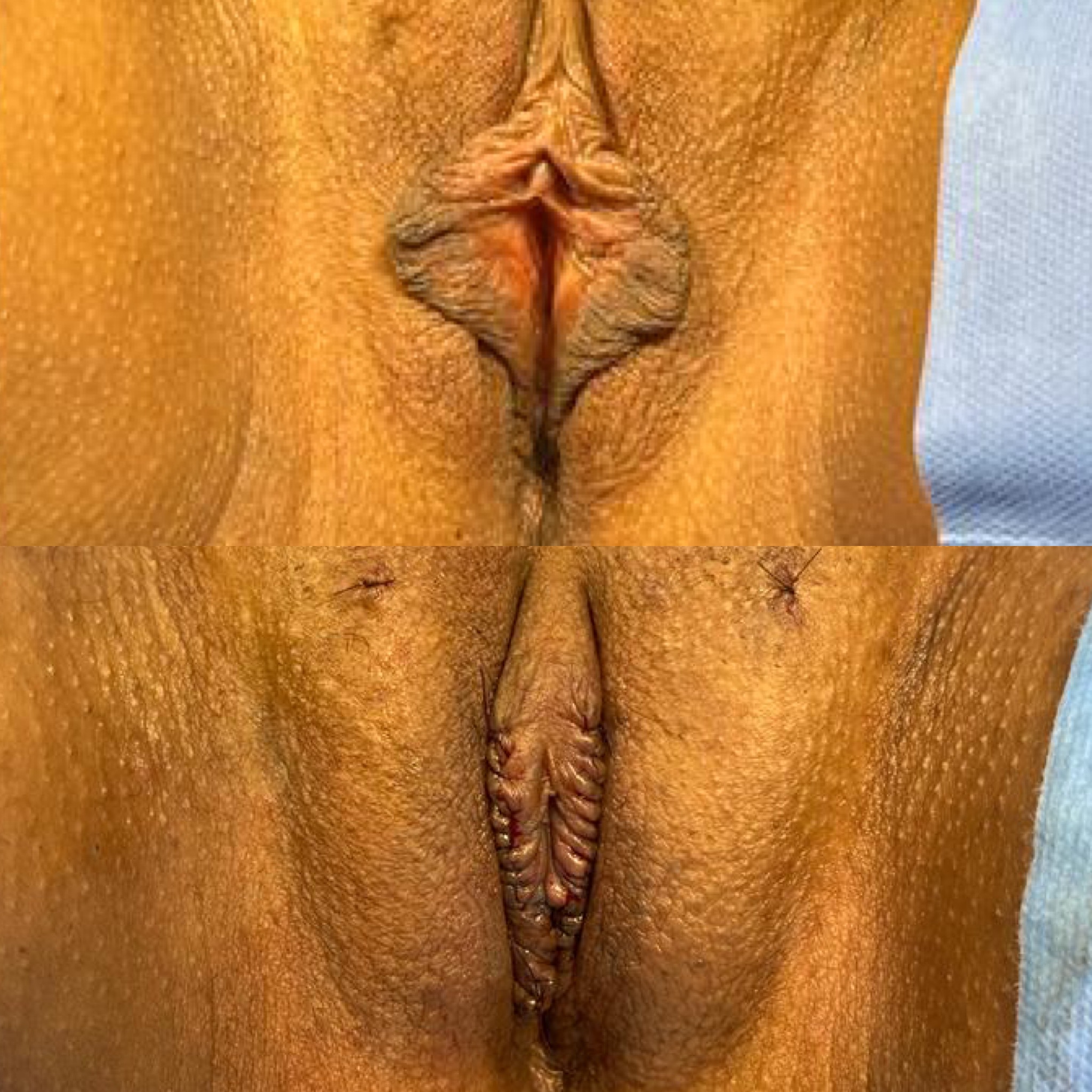Ninfoplastia — antes e depois