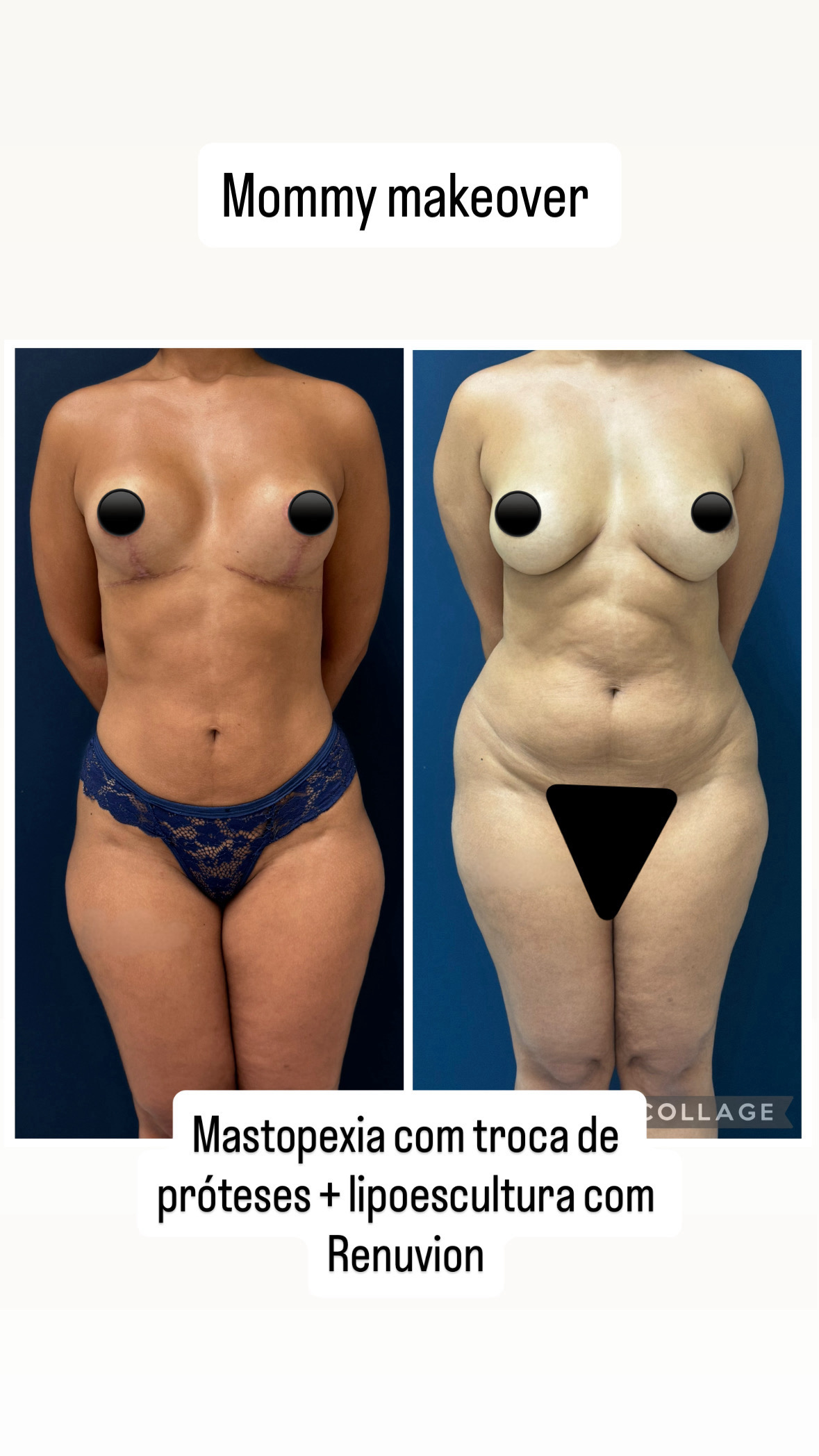 Lipoescultura - Out 2025