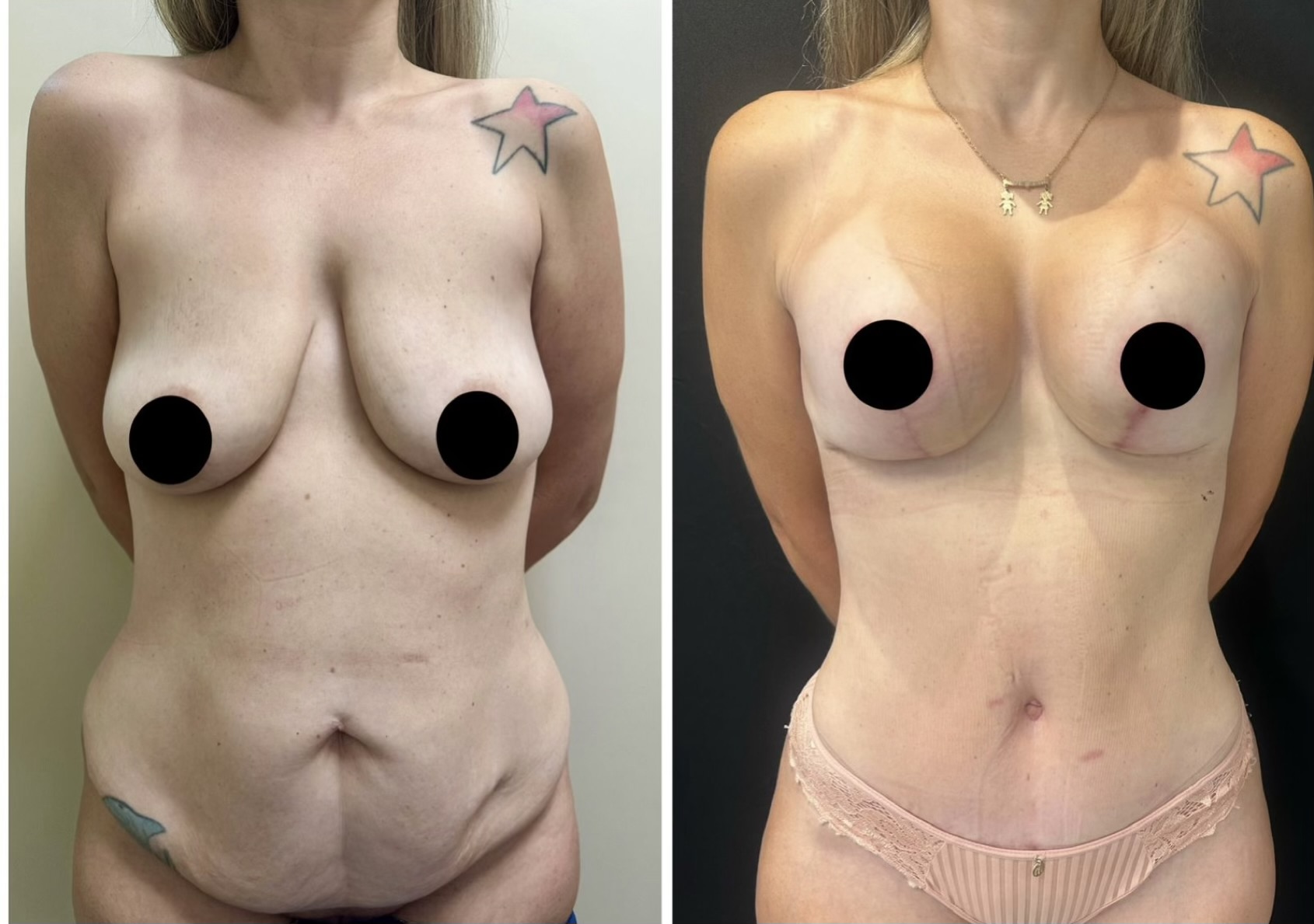 Abdominoplastia — antes e depois