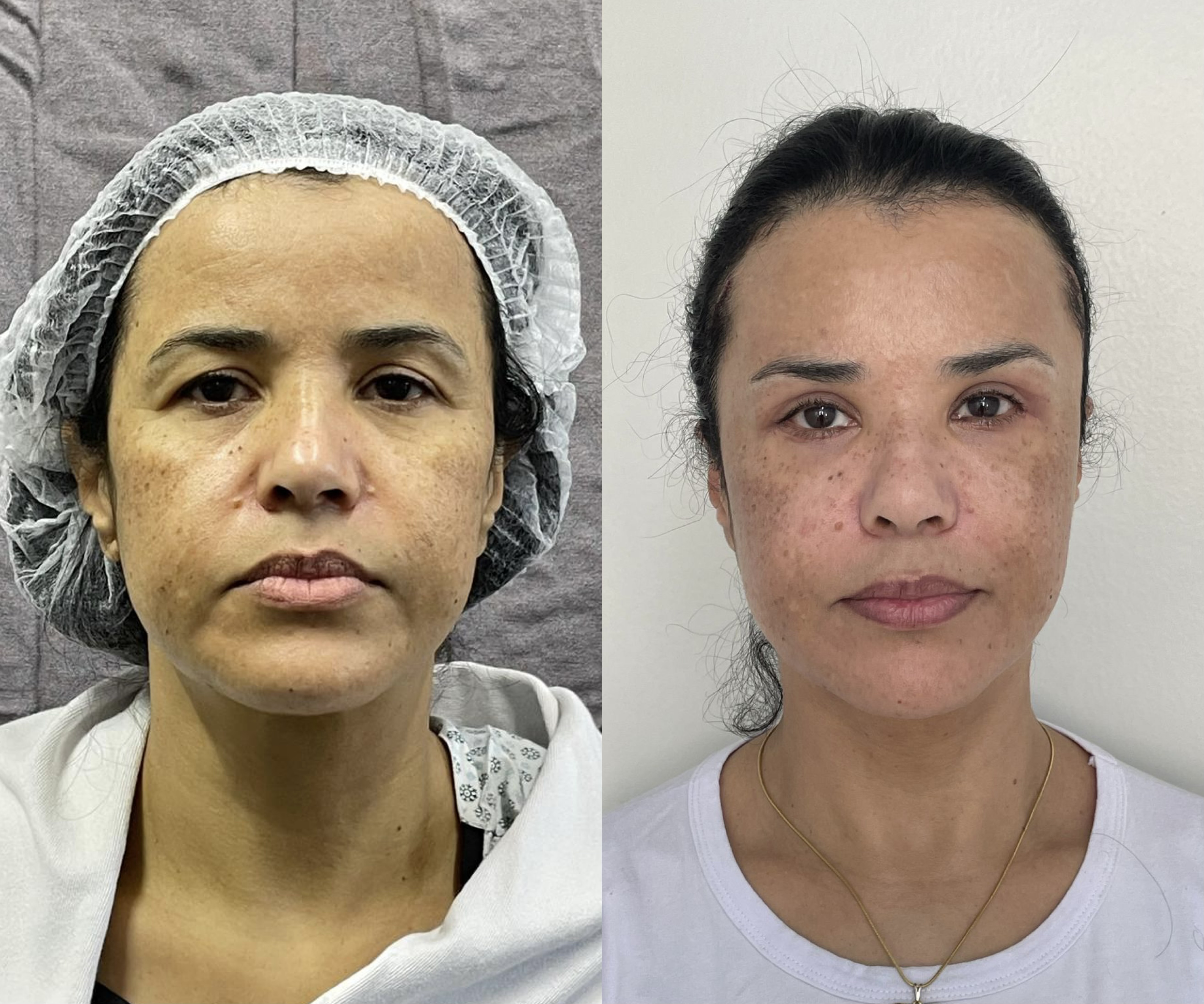 Blefaroplastia — antes e depois