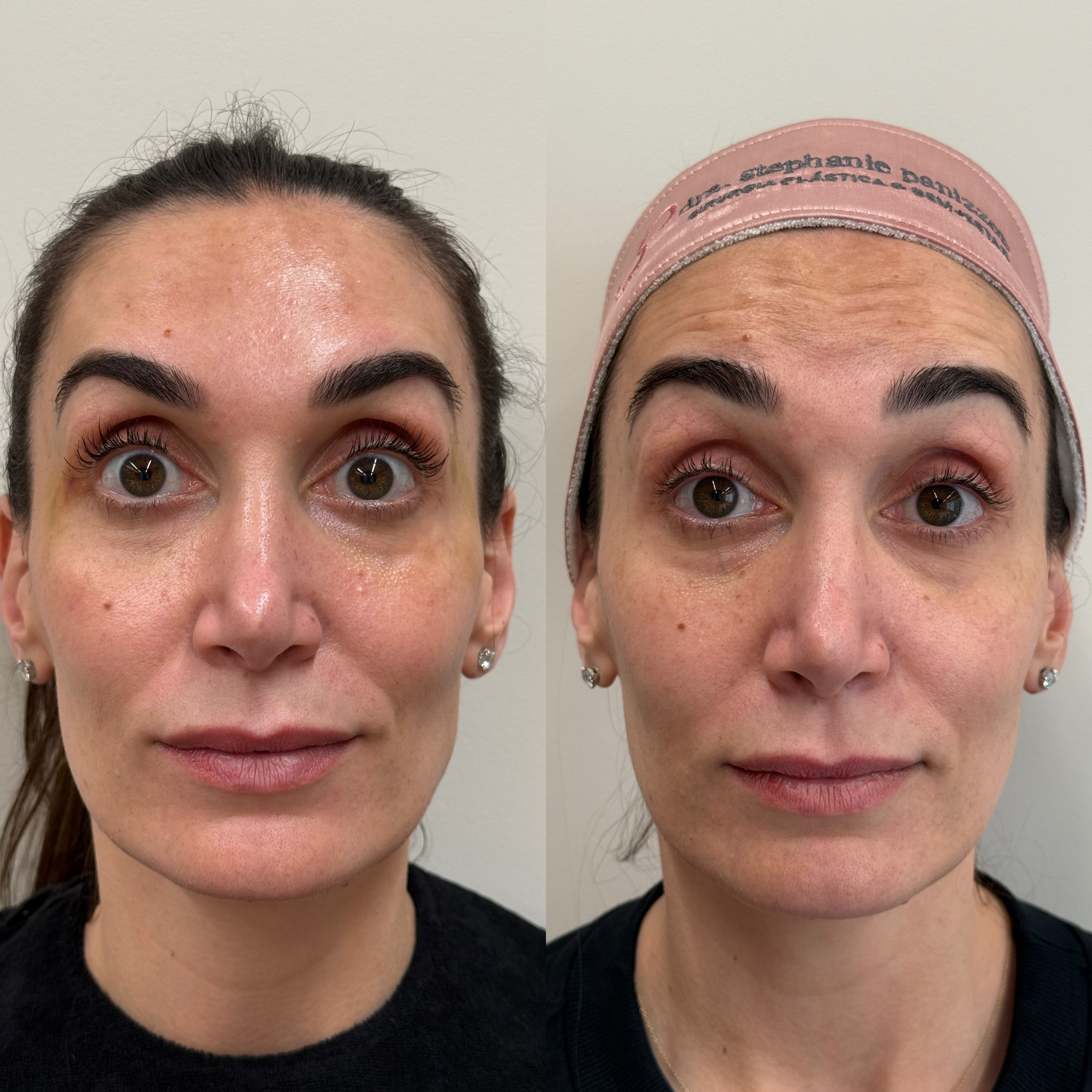 Cosmiatria — antes e depois