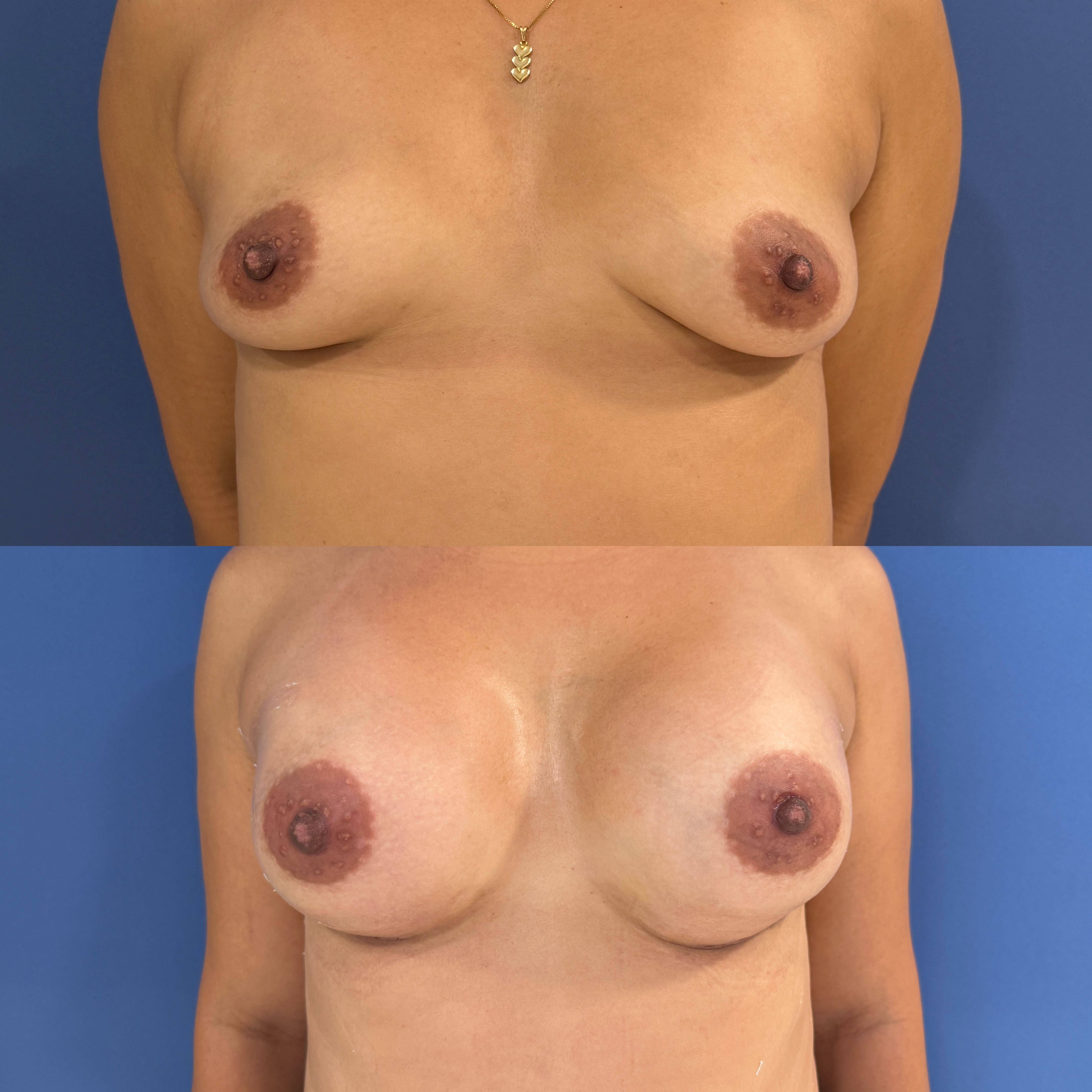 Mamoplastia — antes e depois