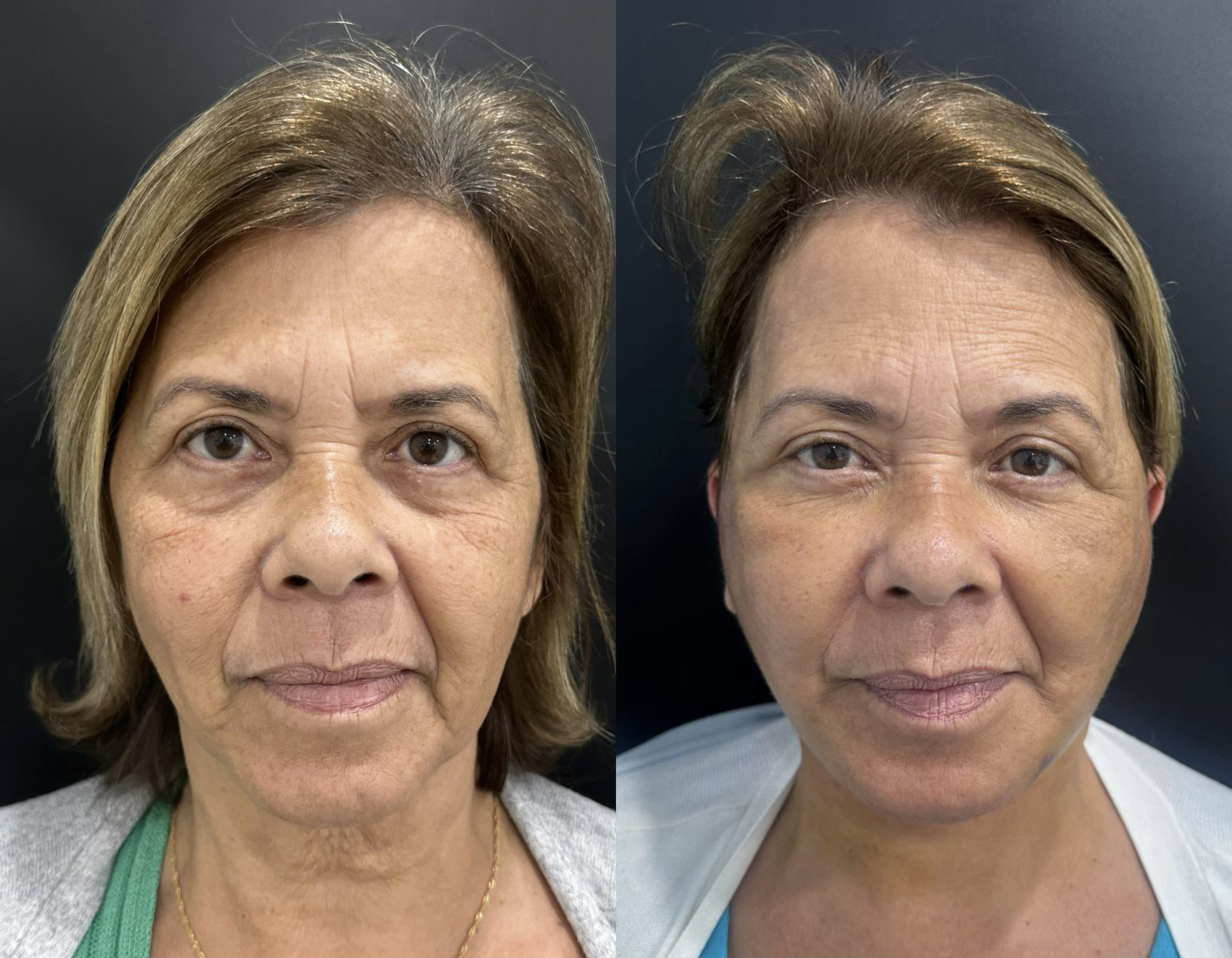 Ritidoplastia — antes e depois