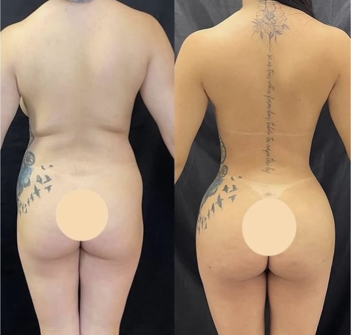 BBL — antes e depois