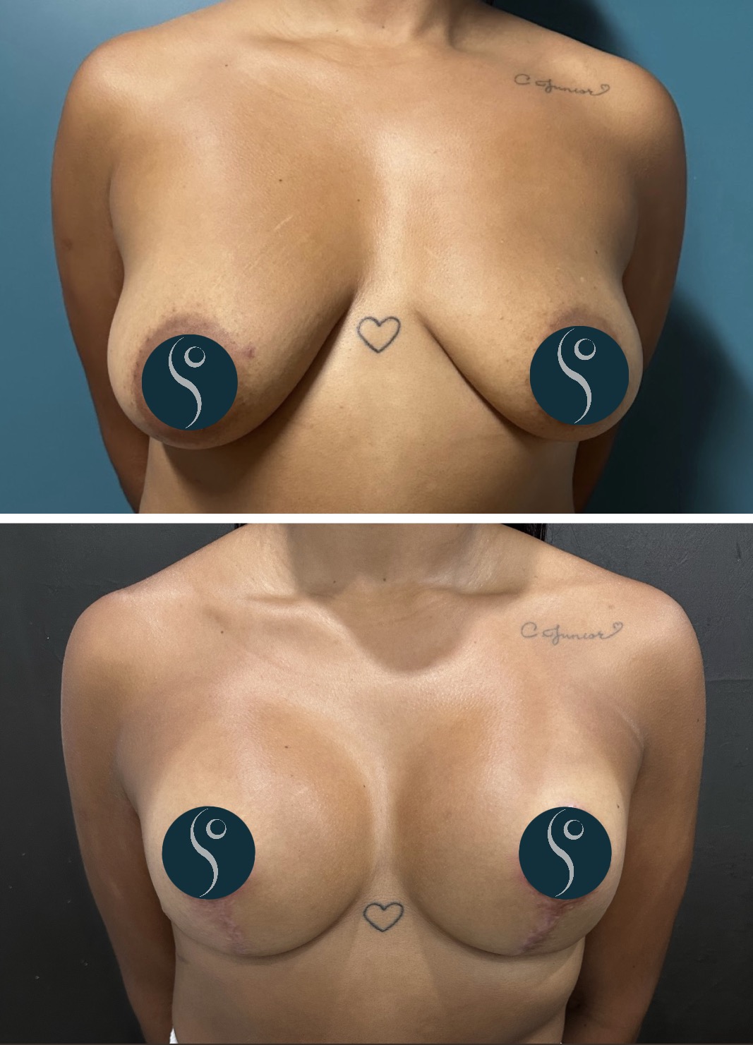 Breast augmentation — antes e depois