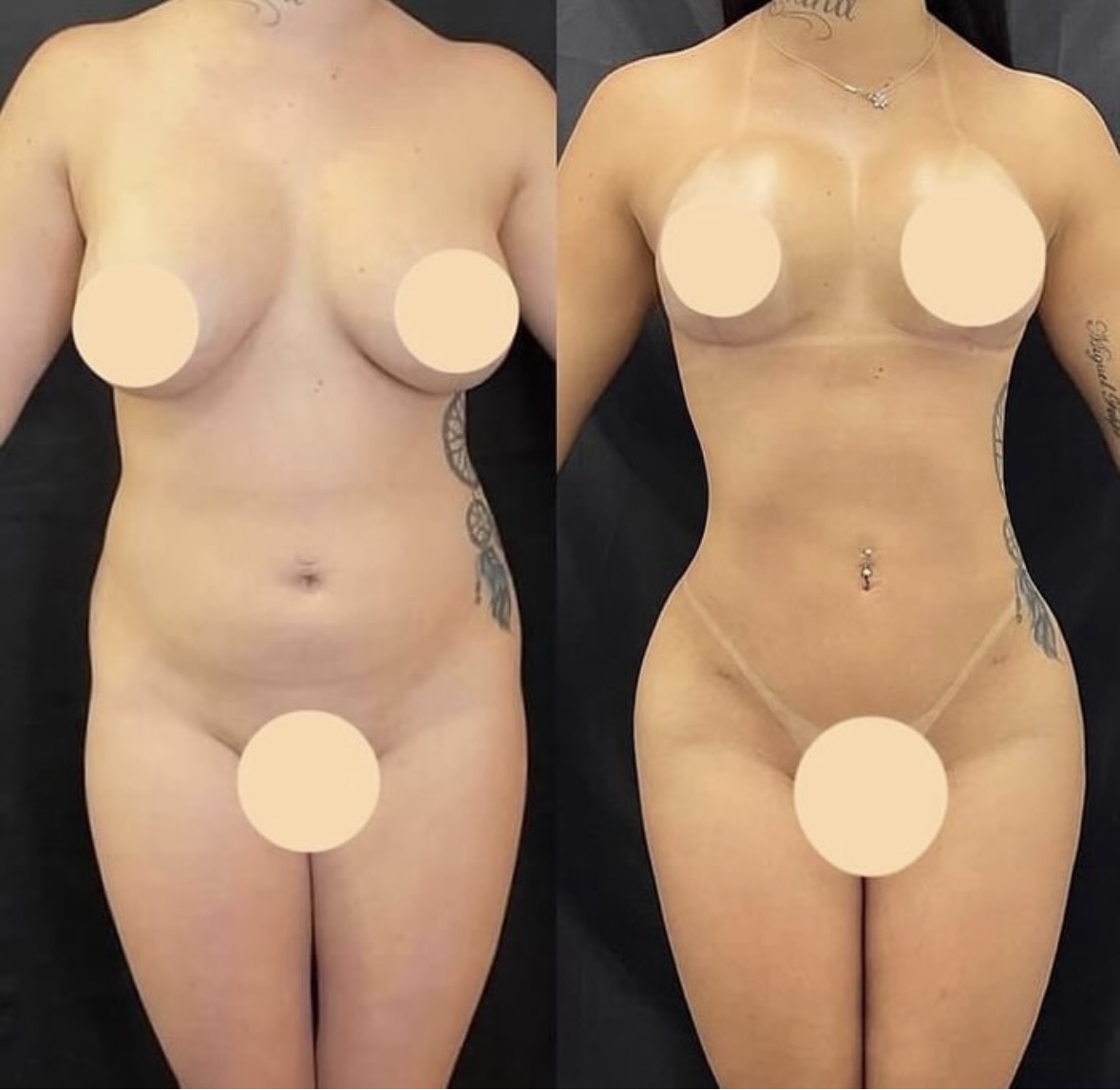 Liposuction — antes e depois