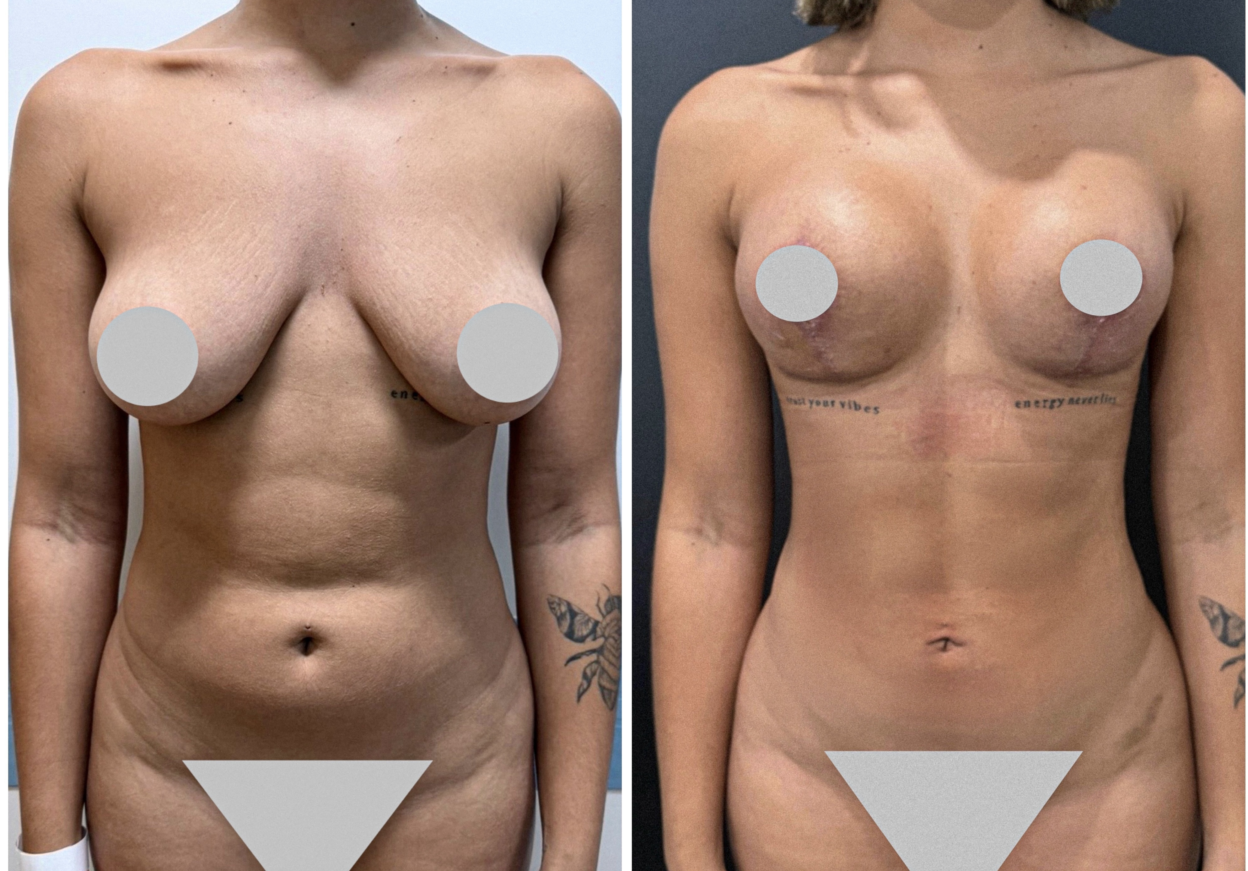 Liposuction — antes e depois