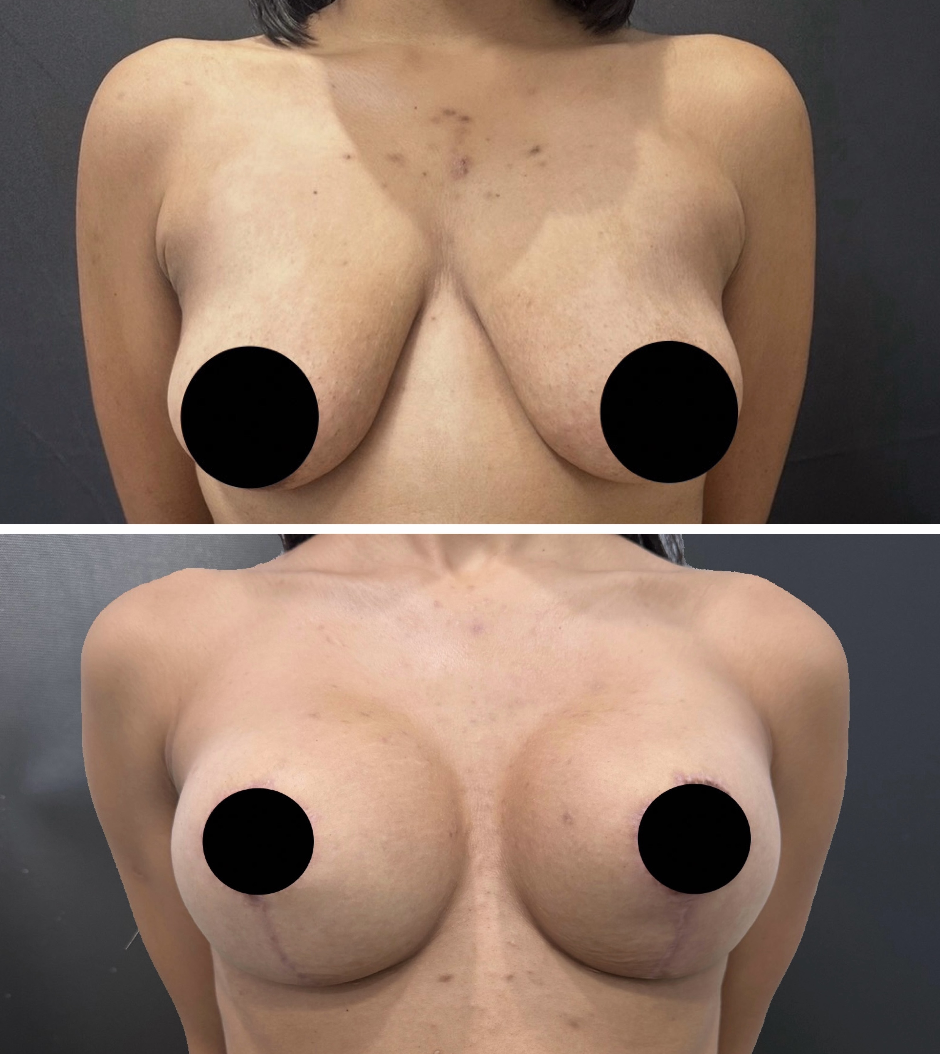 Mamoplastia — antes e depois
