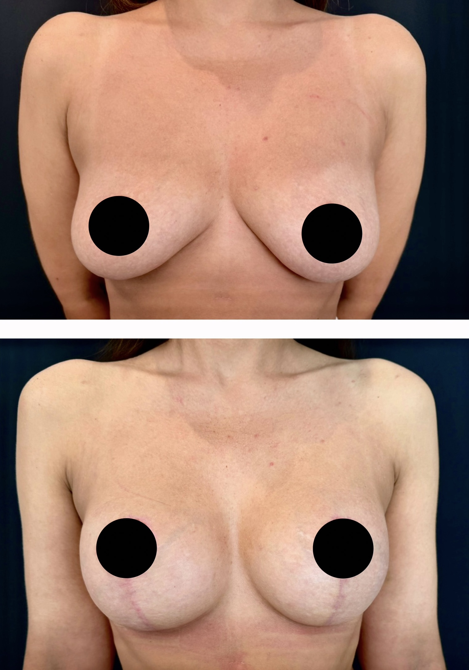 Mamoplastia — antes e depois