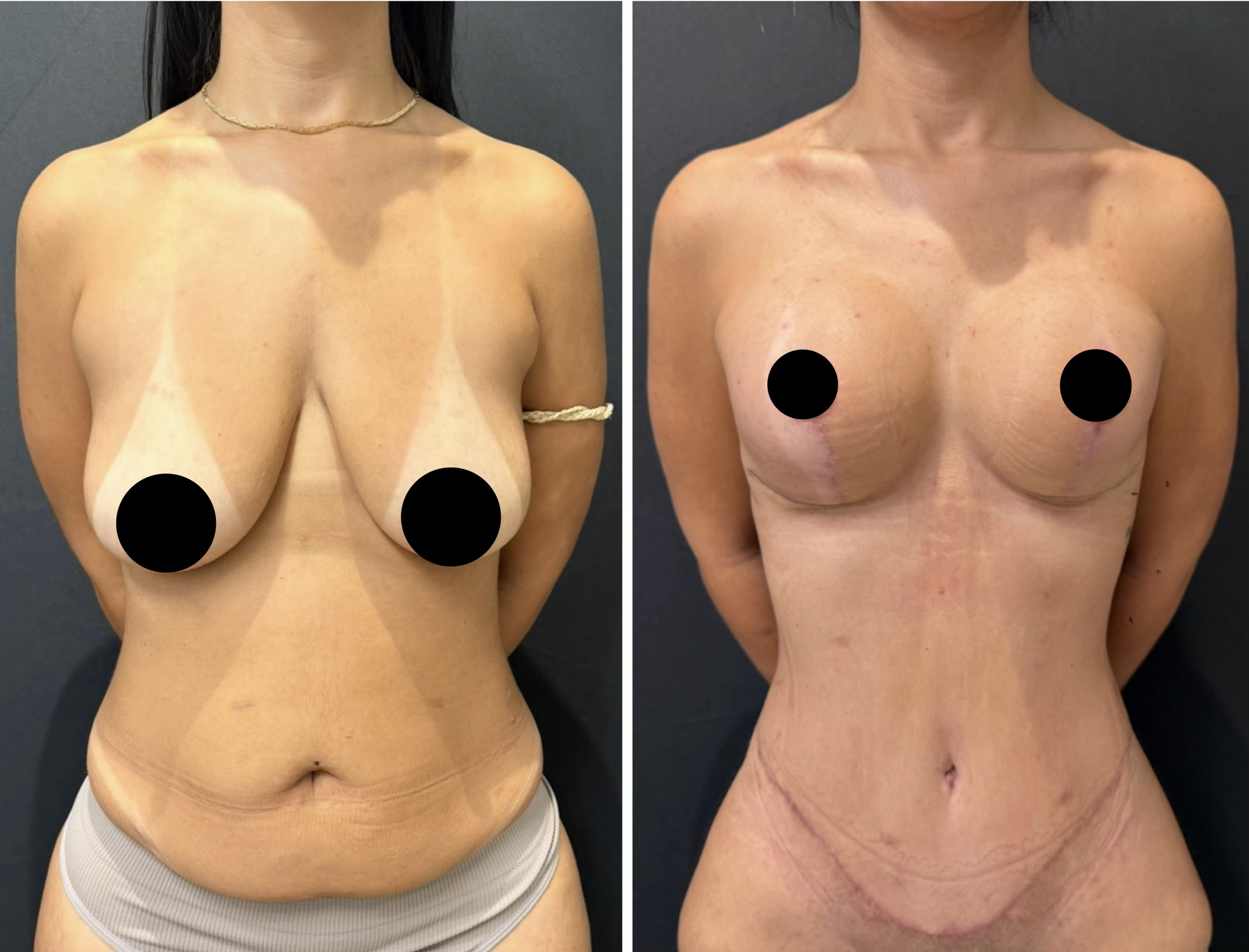 Mommy makeover — antes e depois
