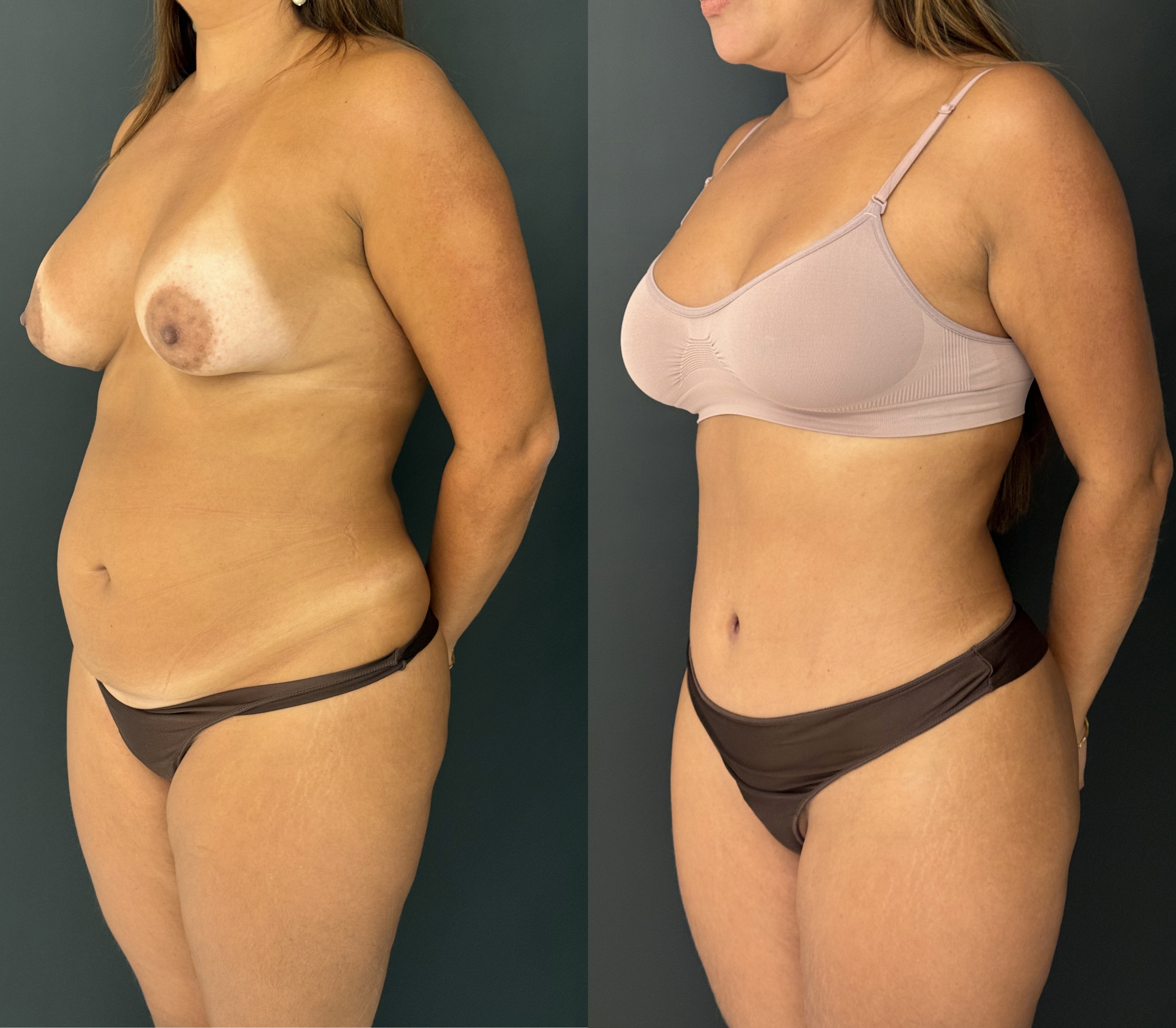 Abdominoplastia — antes e depois