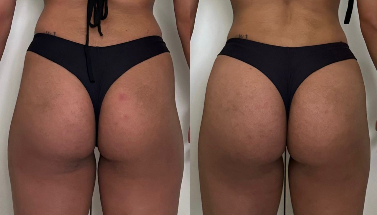 BBL — antes e depois