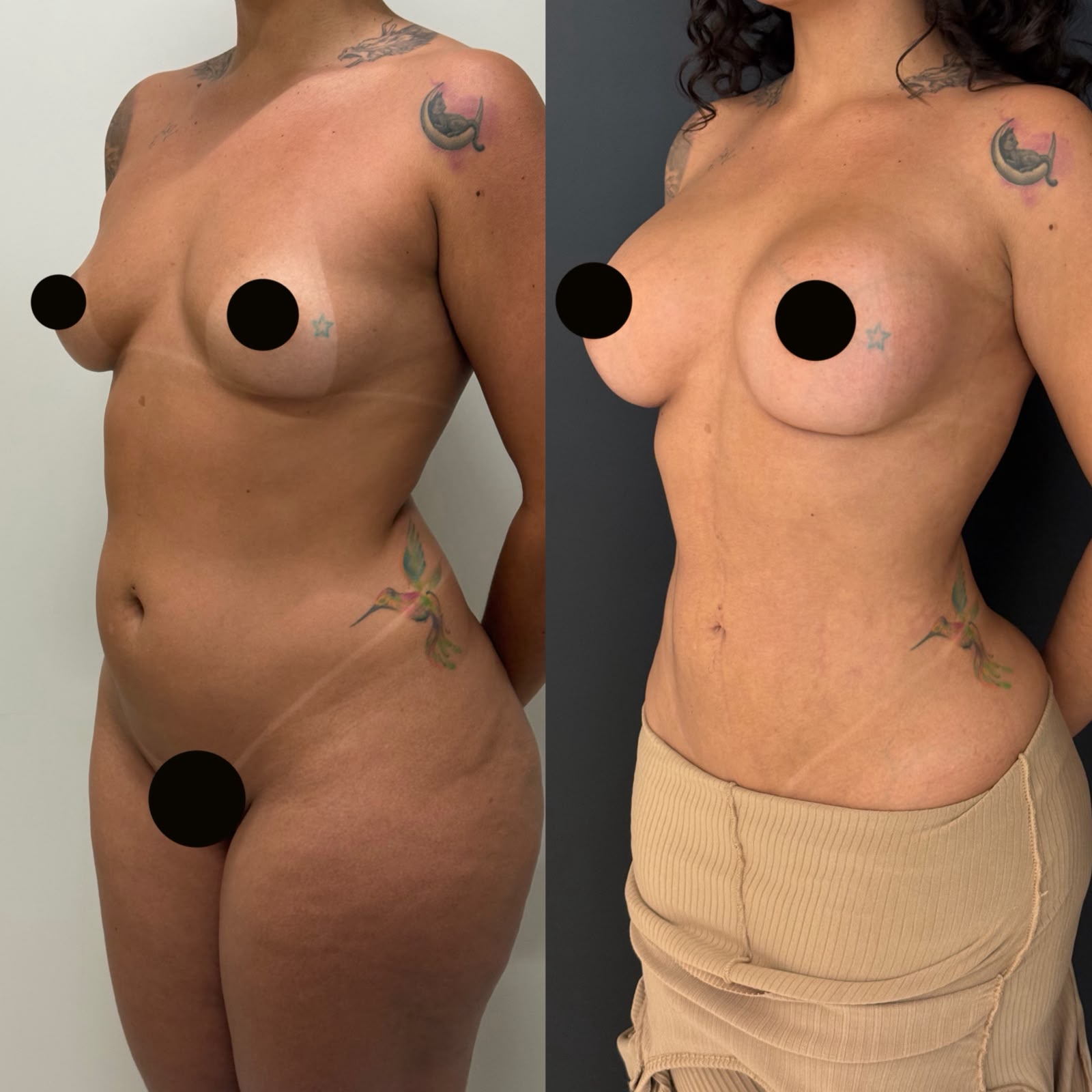 Lipoescultura — antes e depois