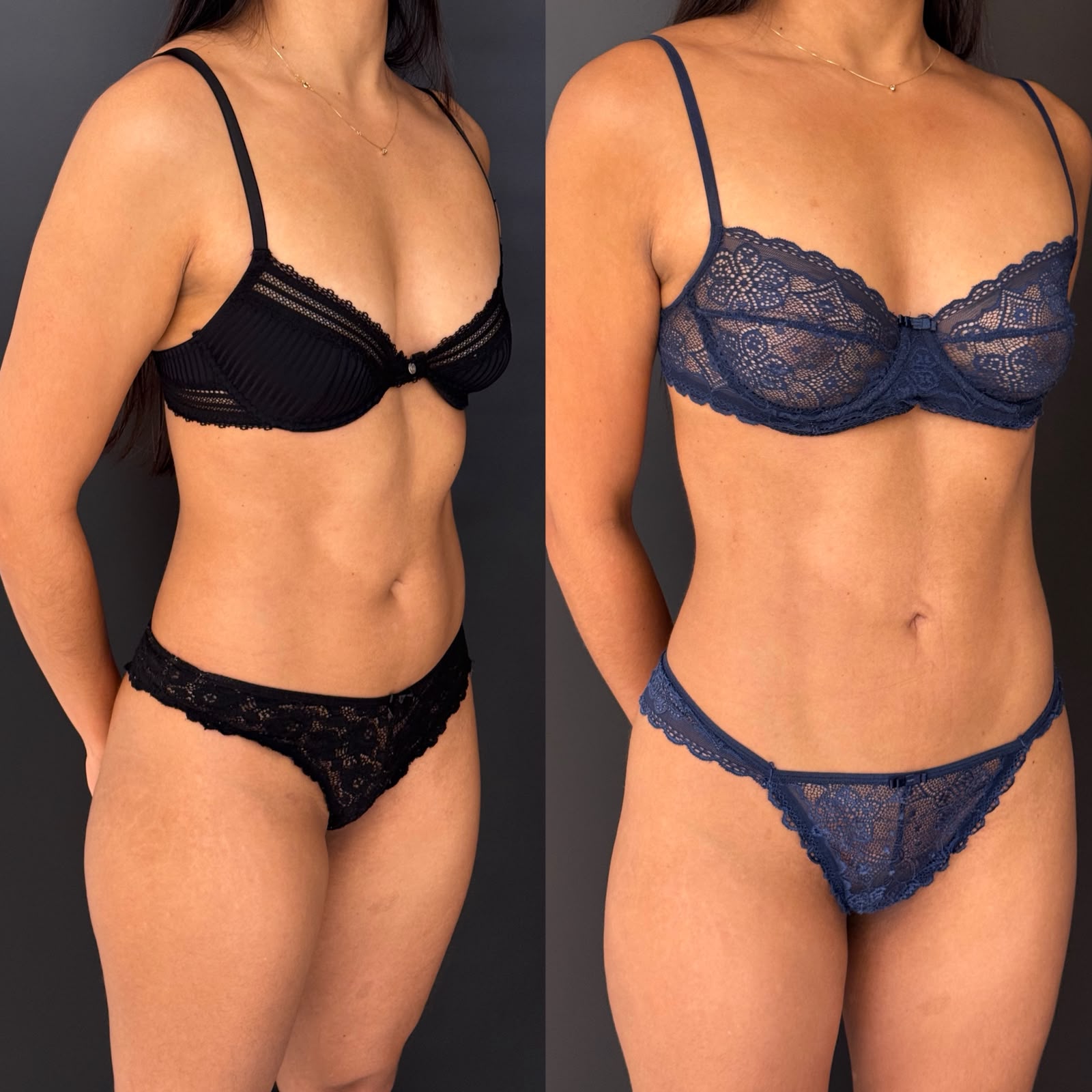 Lipoescultura — antes e depois