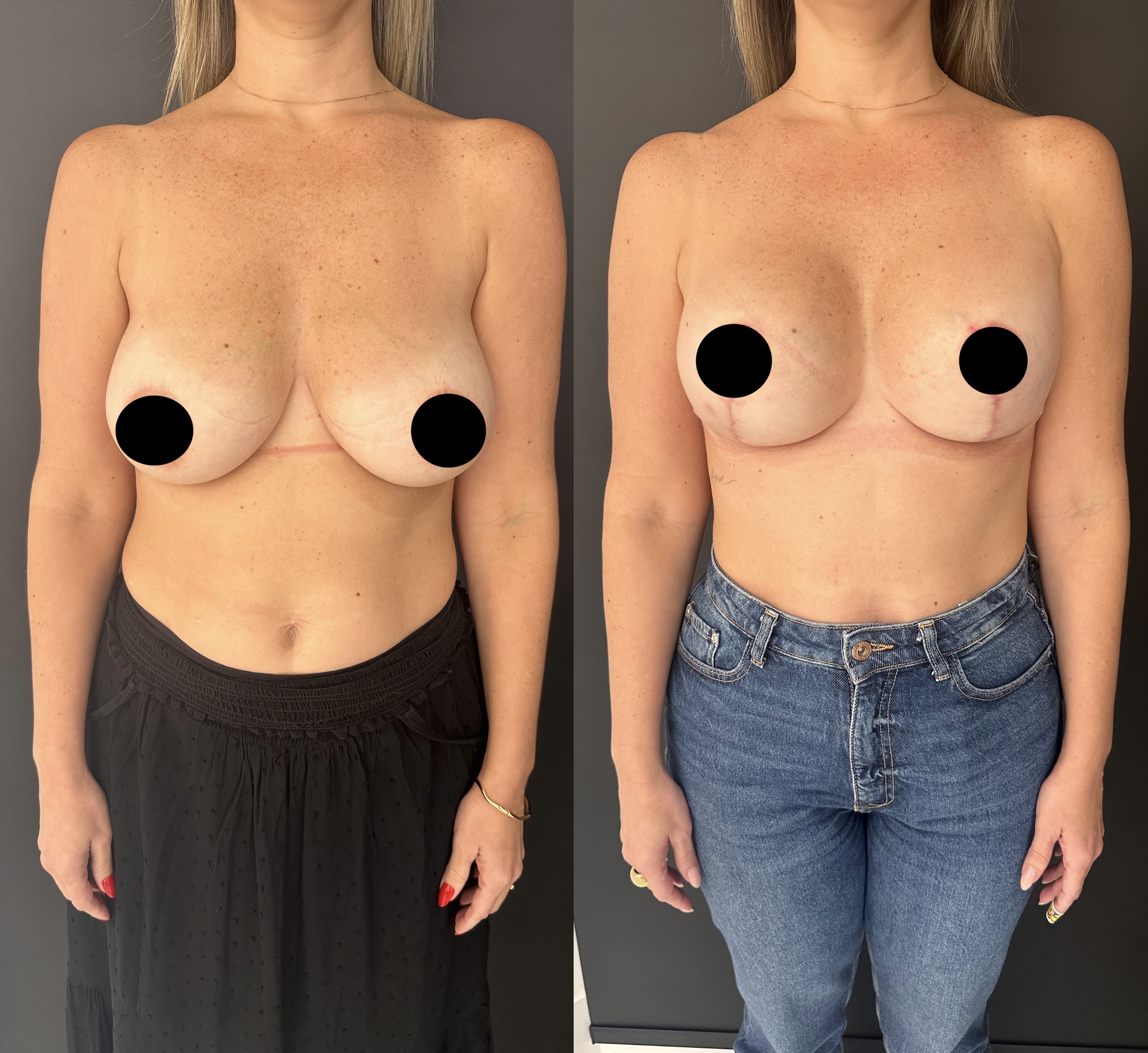Mastopexia — antes e depois