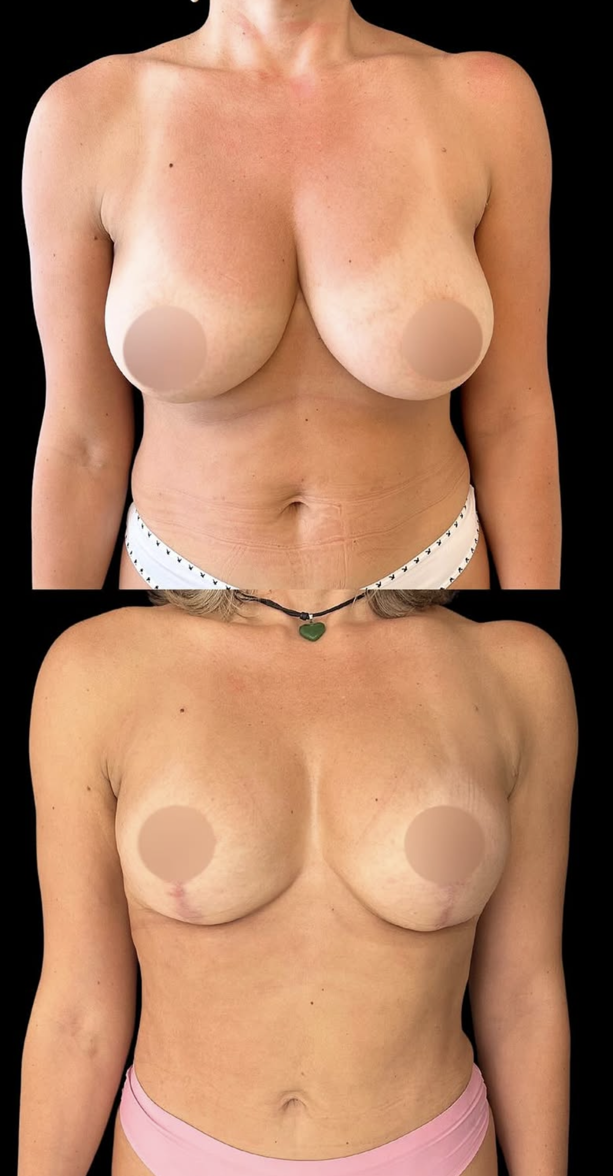 Mastopexia — antes e depois