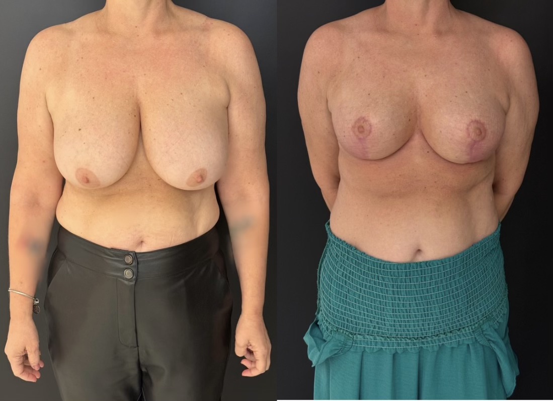 Mastopexia — antes e depois