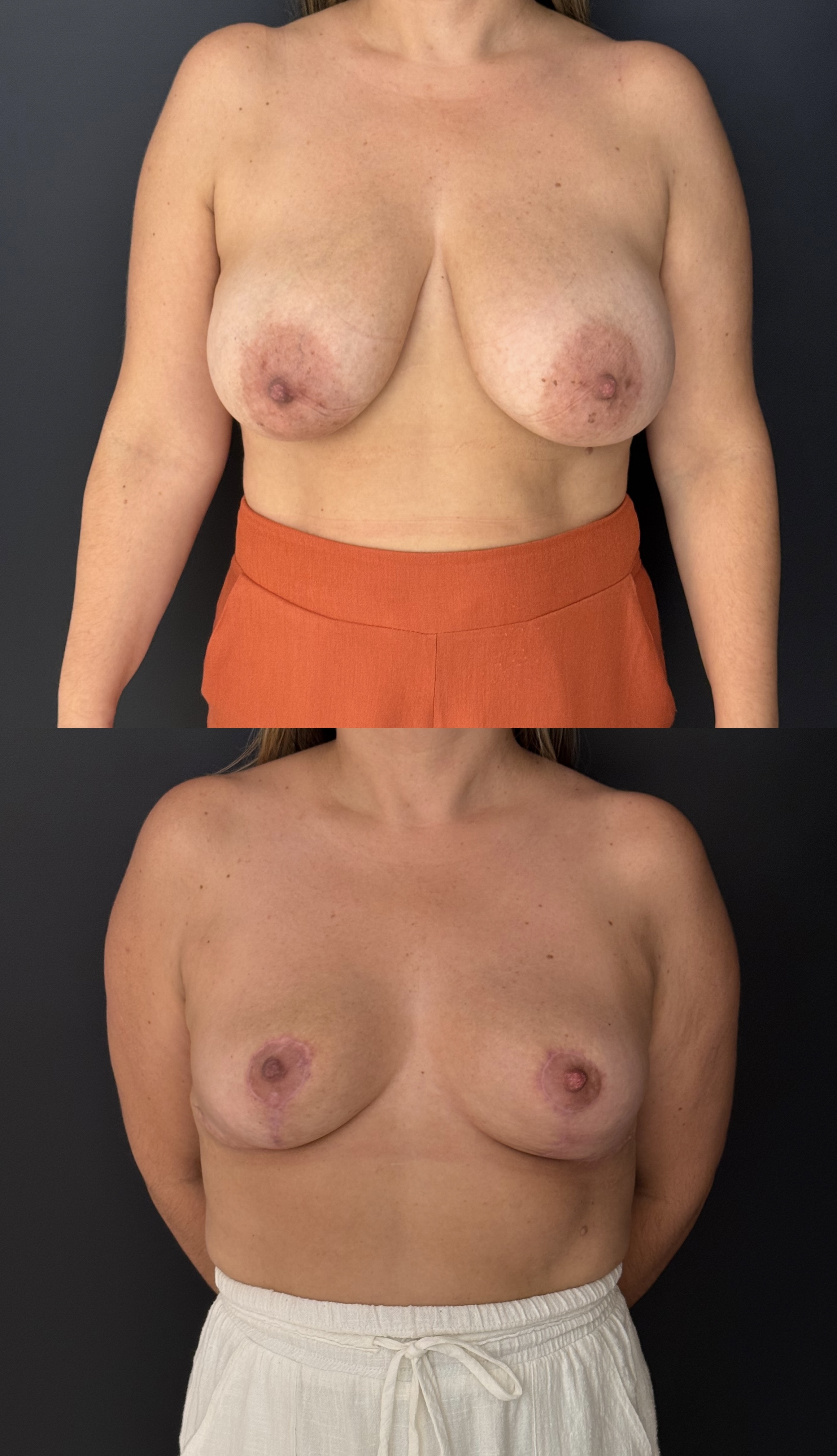 Mastopexia — antes e depois
