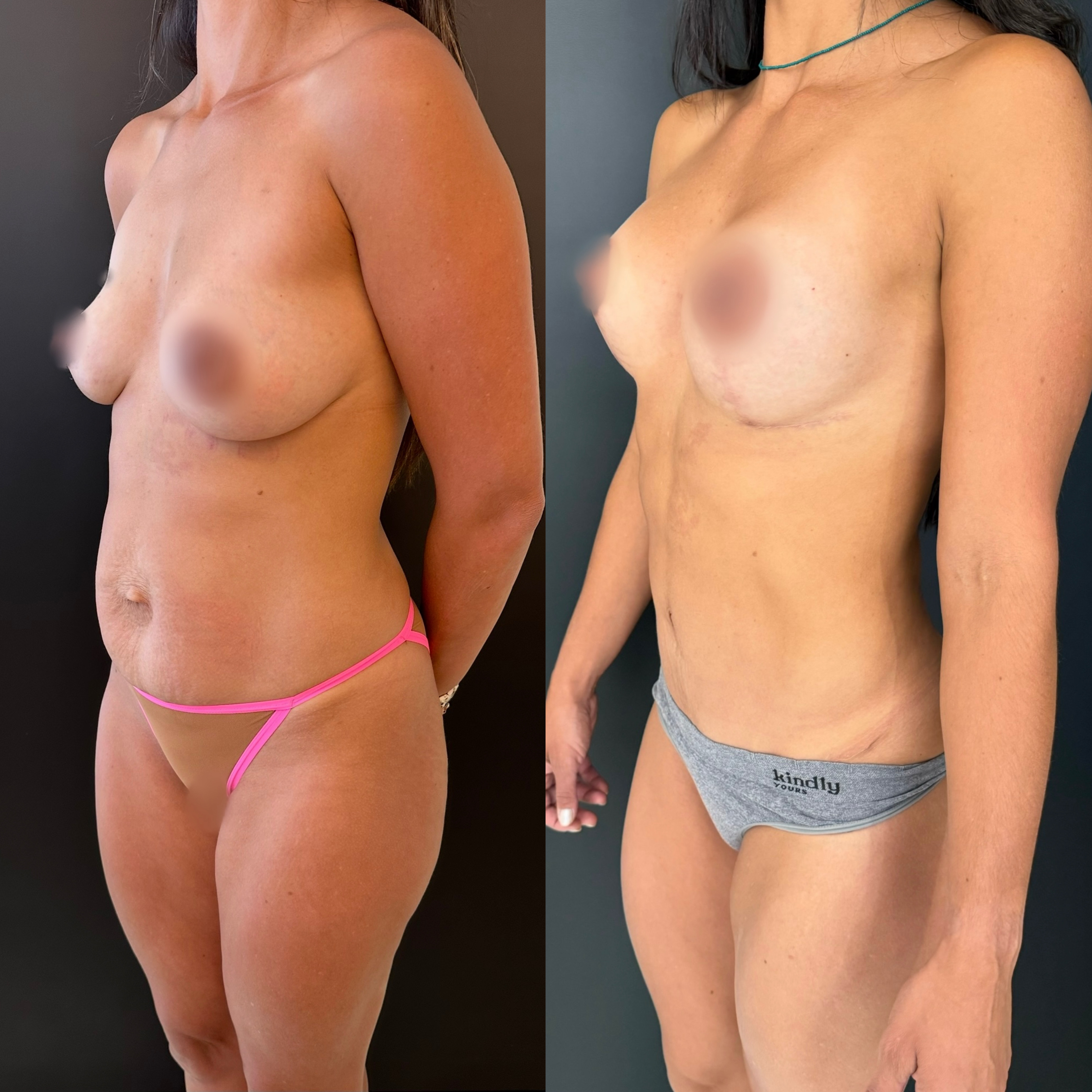 Mommy makeover — antes e depois