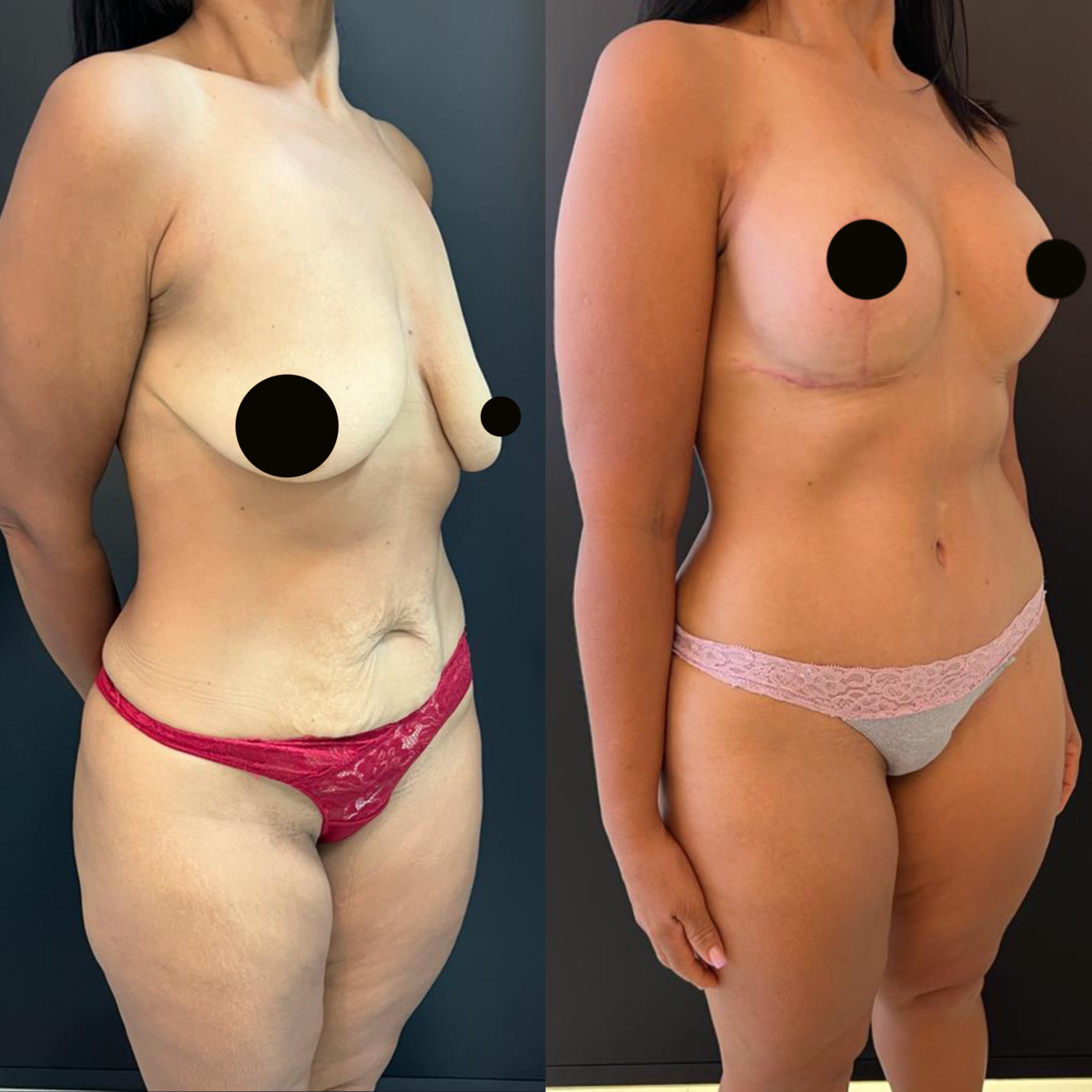 Mommy makeover — antes e depois