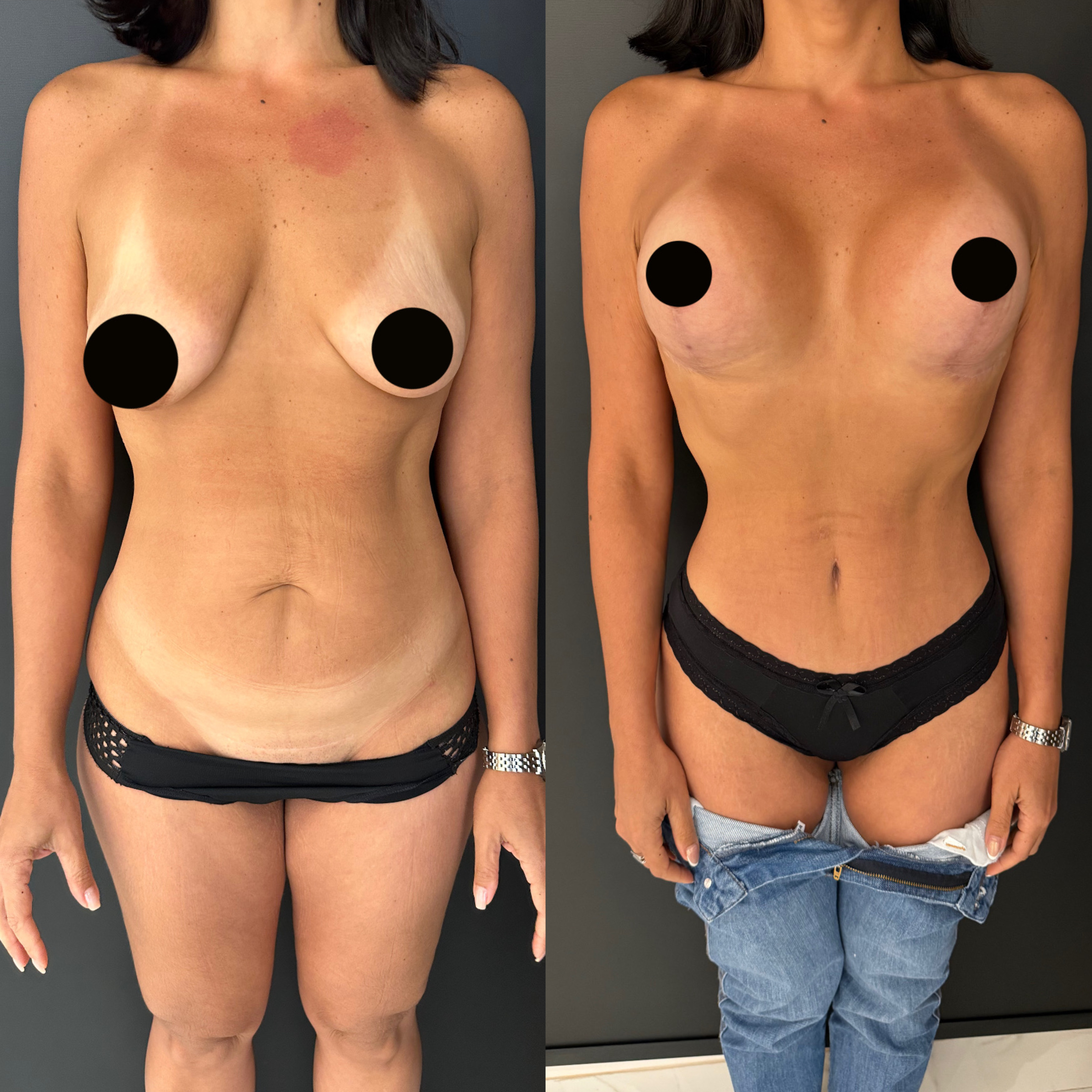 Mommy makeover — antes e depois