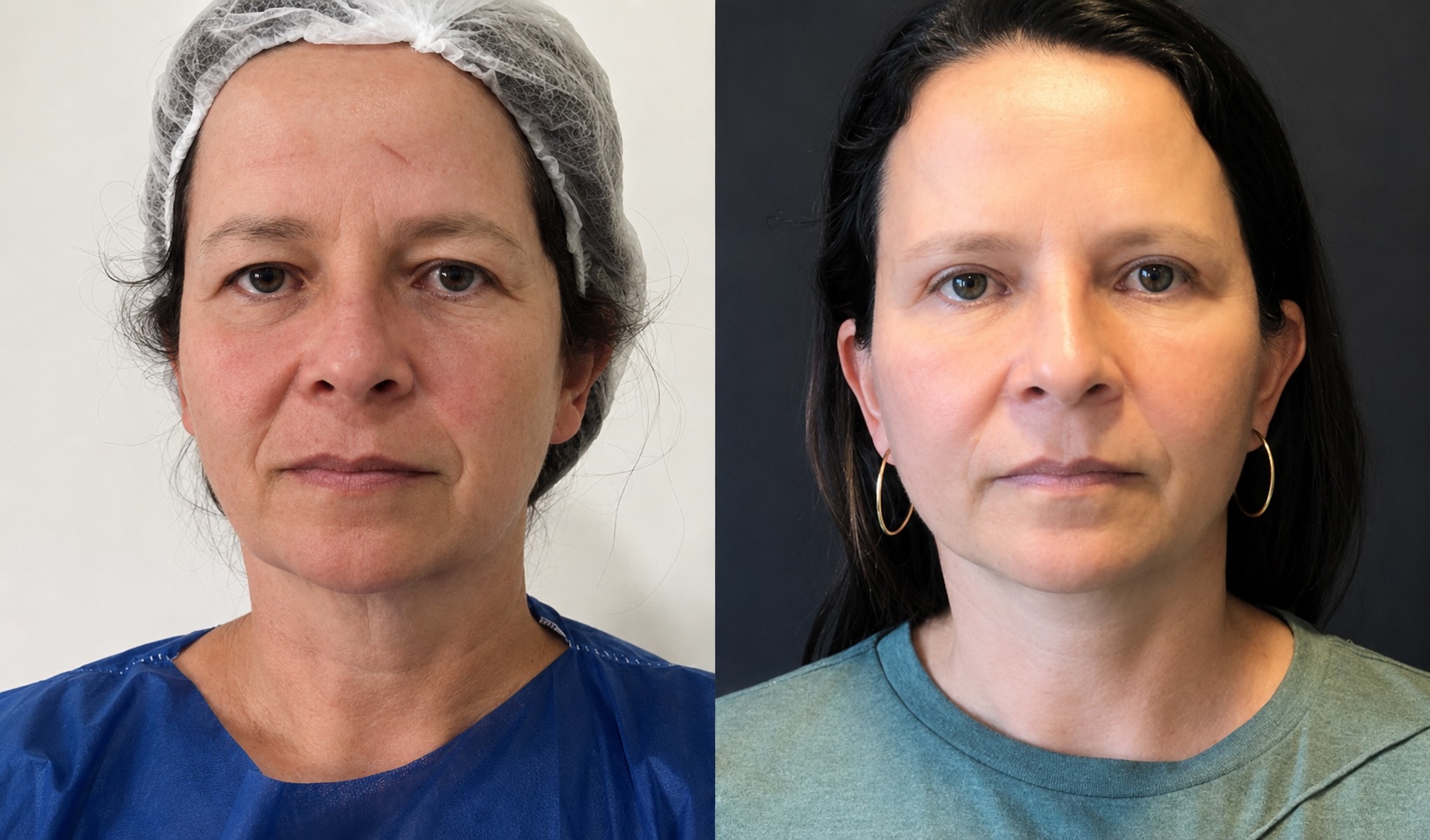 Deep Plane Facelift (+75 Dias) — antes e depois