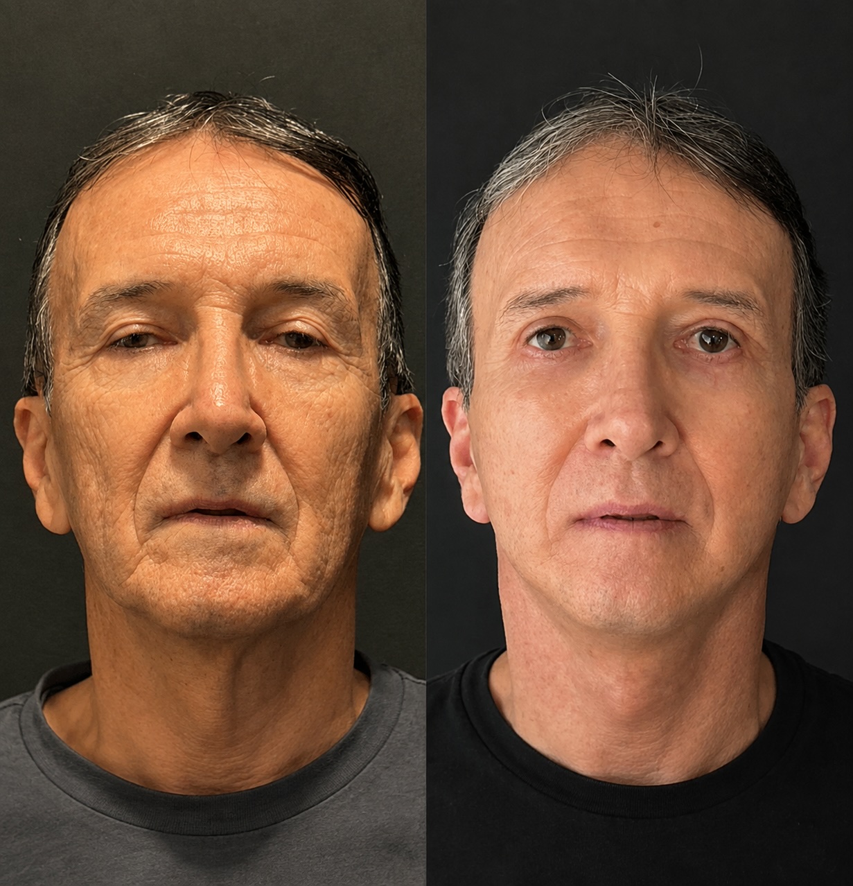 Deep Plane Facelift + Blefaroplastia (+1 mês) — antes e depois