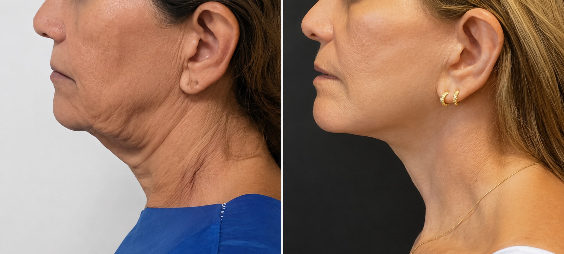 Deep Plane Facelift (+30 Dias) — antes e depois